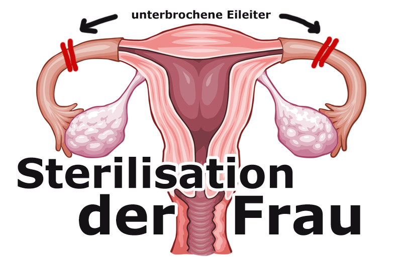 Sterilisation der Frau