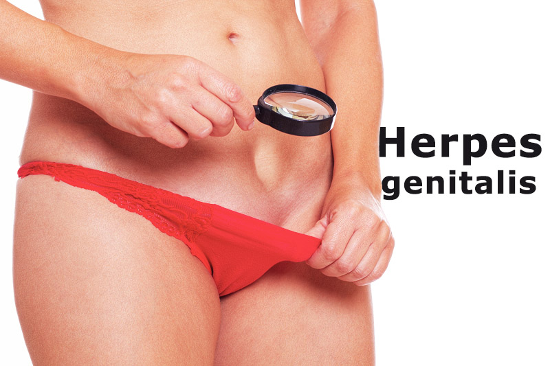 Herpes frau genital Genital Herpes