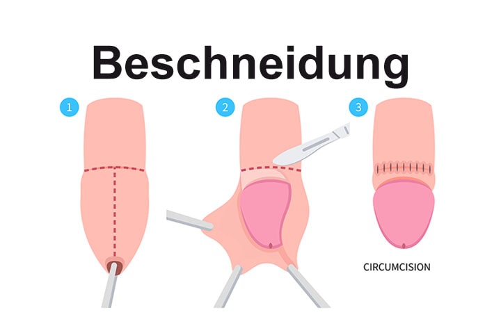 Beschneidung (Zirkumzision)